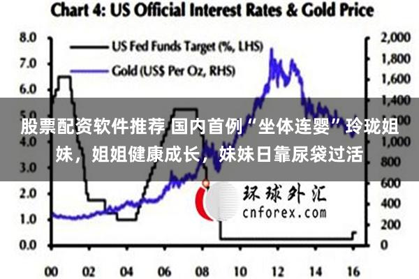 股票配资软件推荐 国内首例“坐体连婴”玲珑姐妹，姐姐健康成长，妹妹日靠尿袋过活